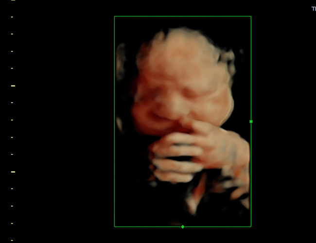 3D ultrasound image at 29 weeks